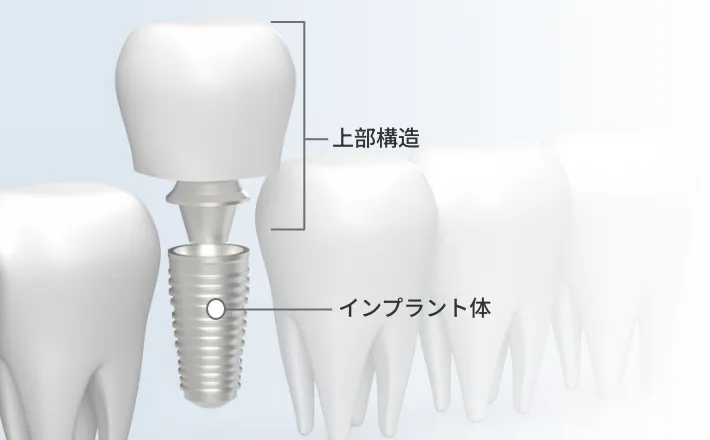 インプラント体と上部構造