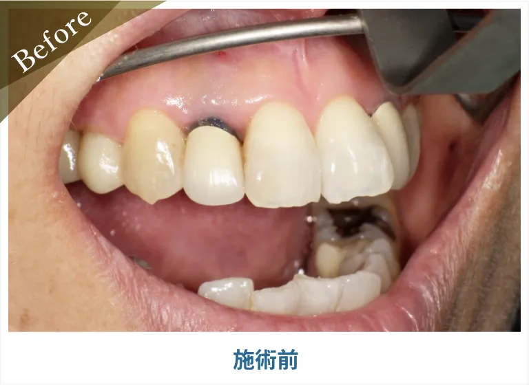(before)前歯を1本欠損