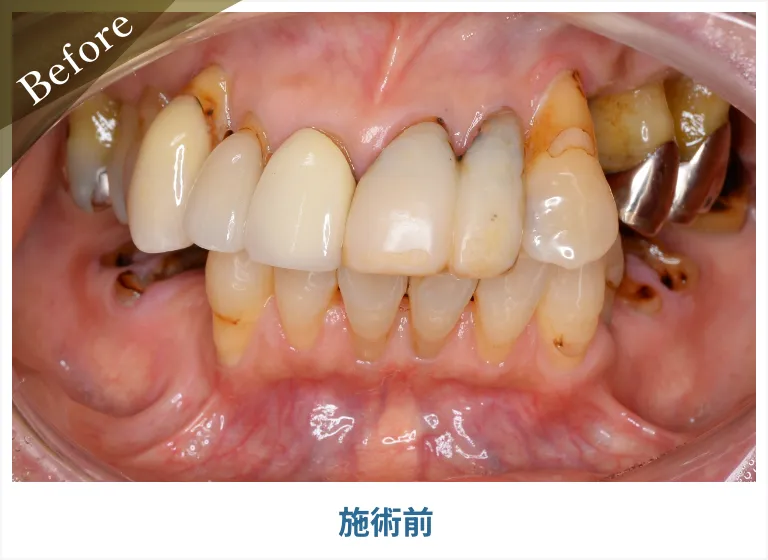 (before)前歯を1本欠損