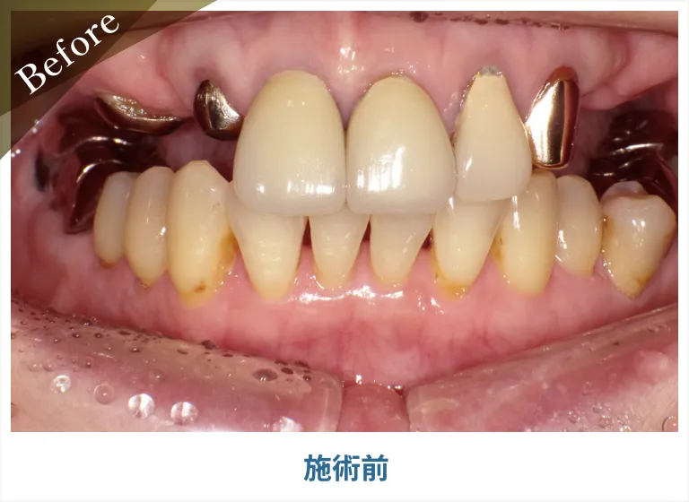 (before)前歯を1本欠損