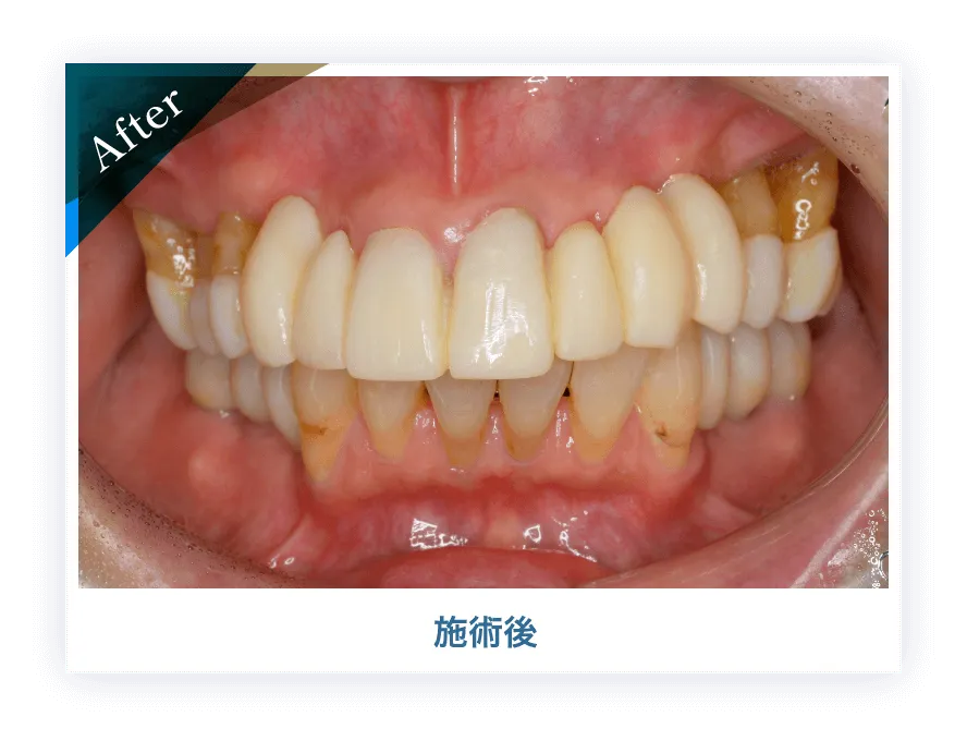インプラント施術後